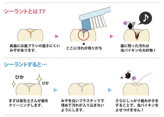 シーラントでむし歯予防