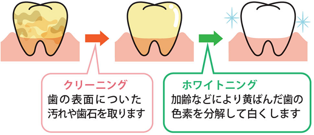 クリーニングとホワイトニング